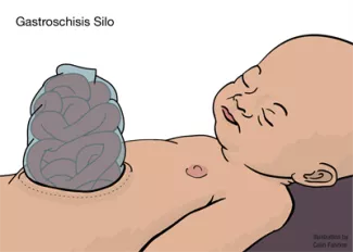 Gastroschisis Silo