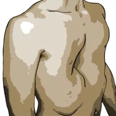 Pectus Excavatum