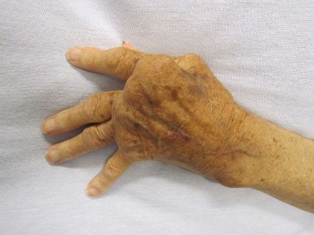 800px-Rheumatoid_Arthritis